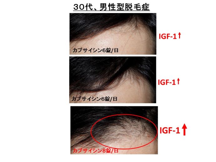 円形脱毛症　病院